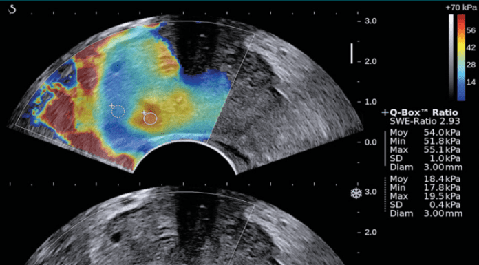 Llega a la Argentina un innovador método de diagnóstico por imágenes que distingue tumores benignos de malignos