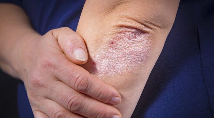 LA PSORIASIS: Te brindamos una diez consejos para mejorar la calidad de vida para aliviar sus efectos