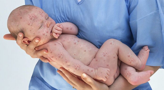 Más de 22 millones de bebés no fueron vacunados contra el sarampión en el mundo en 2020