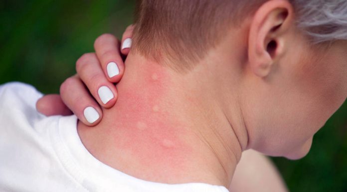 Efeméride: Se conmemora el Día Internacional contra el Dengue enfermedad transmitida por la picadura de mosquitos infectados