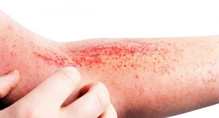 Norit - Hoy es el día mundial de la Dermatitis atópica, un trastorno que  provoca el enrojecimiento de la piel y picazón🔥. Aunque por supuesto lo  que te recomendamos es que vayas