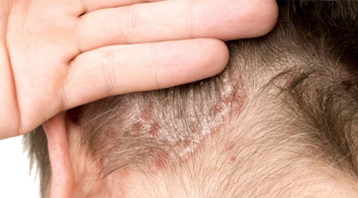 29 de octubre: Día Mundial de la Psoriasis la enfermedad que afecta a entre el 2 y el 5% de la población