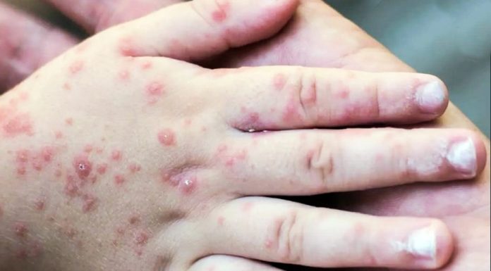 Viruela Símica: Nuevos datos muestran potenciales consecuencias en personas con sistemas inmunológicos debilitados