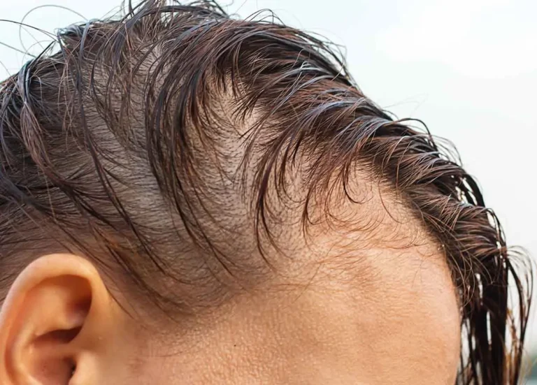 Caída del cabello: Cada vez más gente joven consulta porque pierden entre 50 y 100 pelos de la cabeza diarios