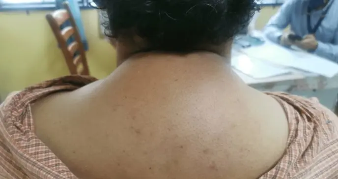 Síndrome de Cushing: causas y tratamiento de una afección poco frecuente generada por el exceso de cortisol