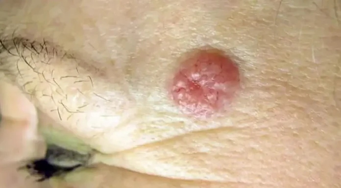 Día Mundial Cáncer de Piel: “Señales para detectar y prevenir uno de los cánceres más frecuentes del planeta”