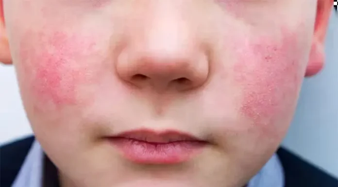 Qué es la “quinta enfermedad” y por qué están creciendo los casos en el mundo