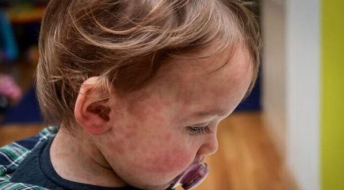 Sarampión: alerta epidemiológico en la región por un aumento exponencial de casos