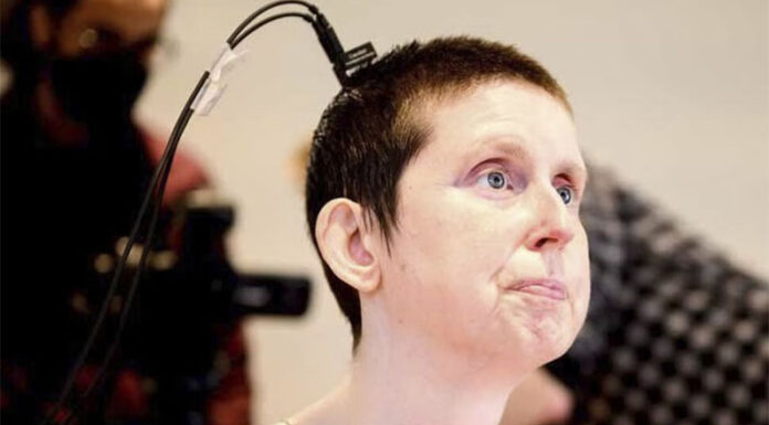 Una mujer volvió a hablar después de 18 años gracias a un implante cerebral con IA