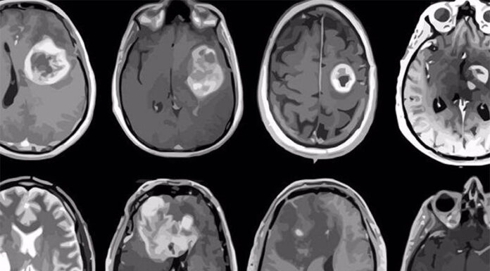 Descubren una estrategia experimental para frenar el glioblastoma, el tumor cerebral más agresivo