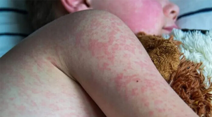 Sarampión: Argentina adelanta a los 18 meses la segunda dosis de la vacuna