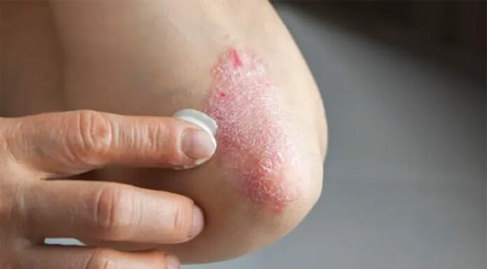 Más del 20% de las personas con psoriasis en Argentina presenta formas severas de la enfermedad