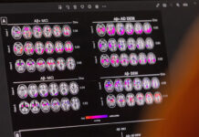 Una proteína tumoral ofrece una pista clave para el tratamiento del Alzheimer