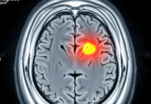 Las drogas psicoactivas duplican el riesgo de sufrir un ACV, incluso en jóvenes