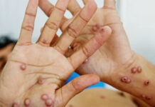 Confirman en Argentina un caso de viruela símica de la variante más contagiosa