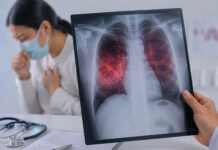 Tuberculosis, récord y preocupación: los casos aumentaron más del 70% en el país desde 2020
