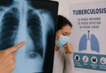 Aumento de casos de tuberculosis: cómo gestionar un subsidio de la provincia para sostener la medicación