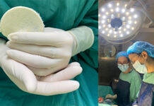Con parches de placenta humana, logran cicatrizar una herida compleja